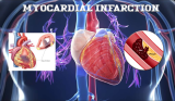 2 Myocardial Infractions Causes