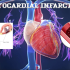 Symptoms Of Myocarditis And What Causes It